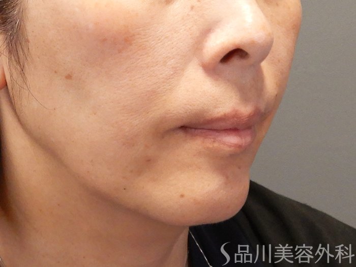 症例NO.70288のAFTER写真