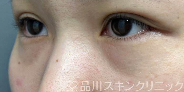 症例NO.65926のBEFORE写真