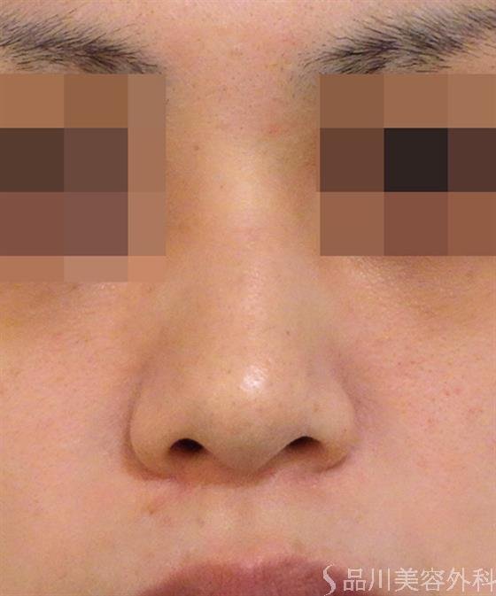 症例NO.39186のBEFORE写真