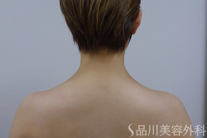 症例NO.73680のAFTER写真