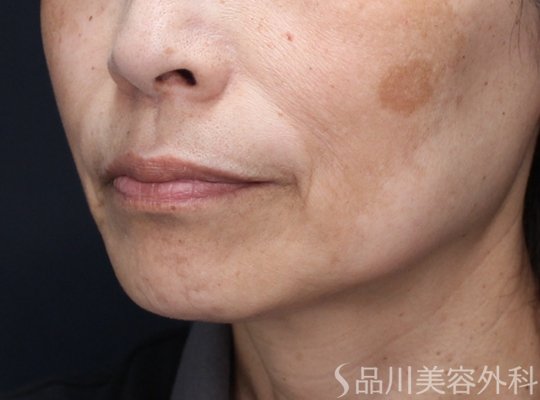 症例NO.74169のBEFORE写真