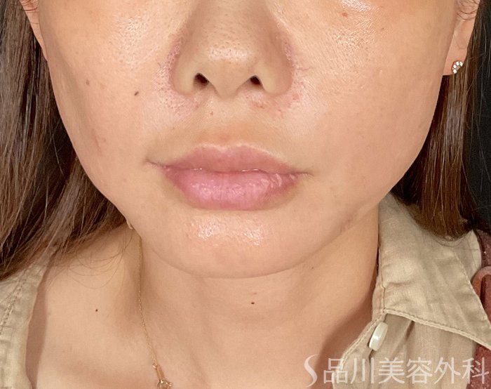 症例NO.75307のAFTER写真