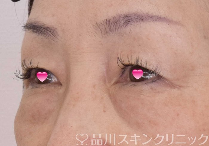 症例NO.69172のBEFORE写真