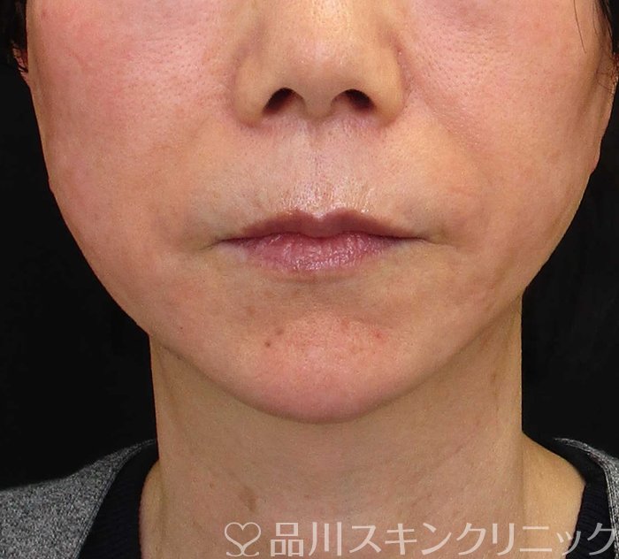症例NO.70254のAFTER写真