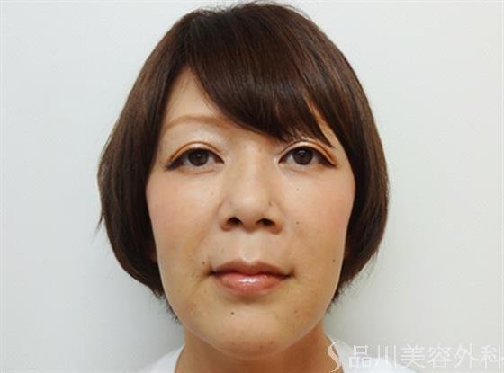 症例NO.26665のAFTER写真