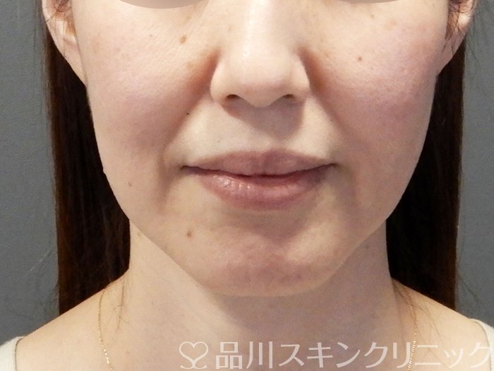 レスチレン処理の準備