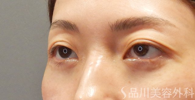症例NO.73999のAFTER写真