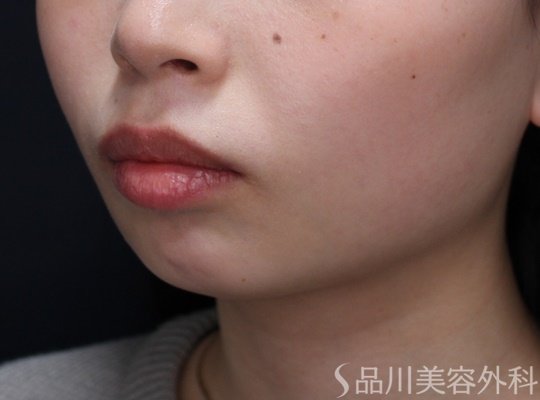 症例NO.69457のAFTER写真