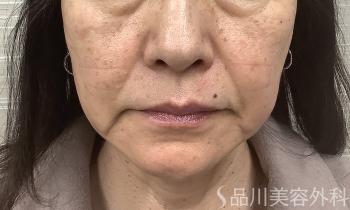 症例NO.62153のAFTER写真