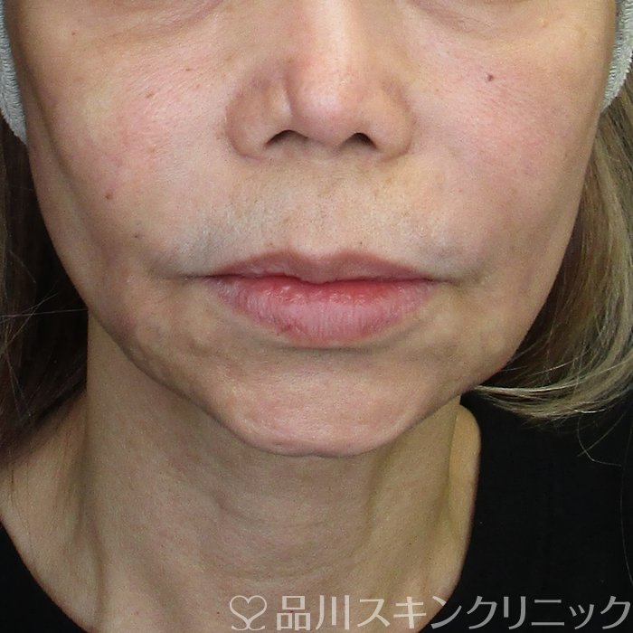 症例NO.75336のAFTER写真