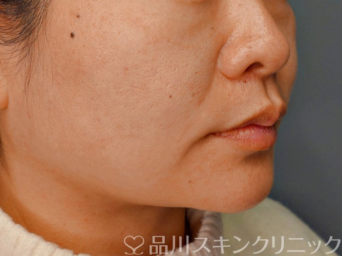 症例NO.73773のBEFORE写真