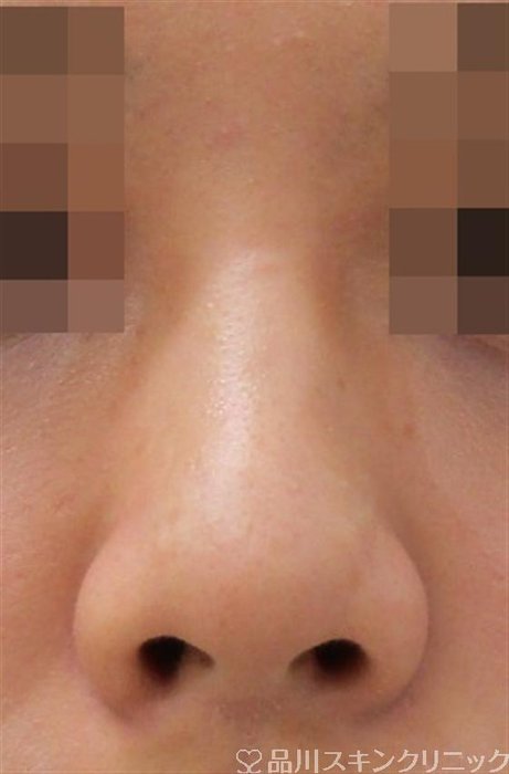 症例NO.40558のBEFORE写真