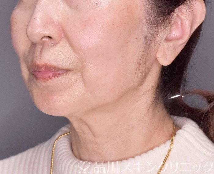 症例NO.70197のBEFORE写真