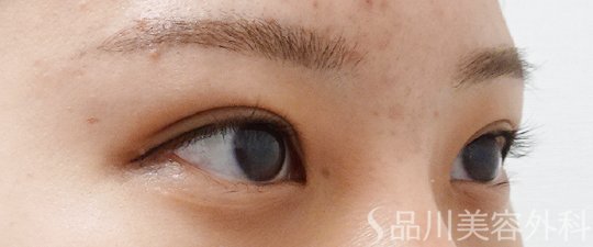 症例NO.62274のAFTER写真