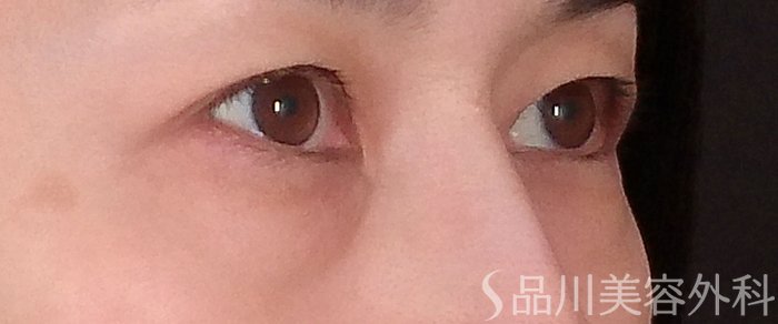 症例NO.70613のBEFORE写真