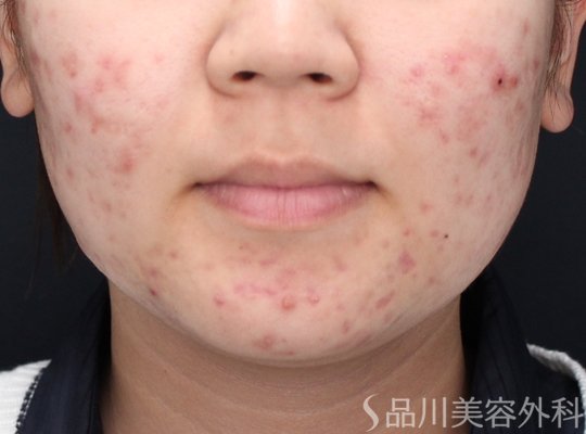 症例NO.73292のBEFORE写真