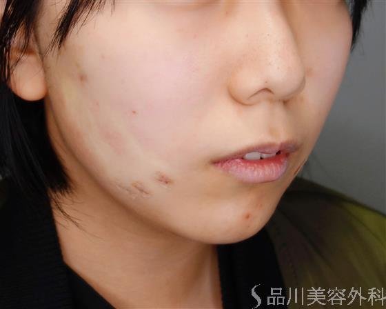 症例NO.50466のAFTER写真