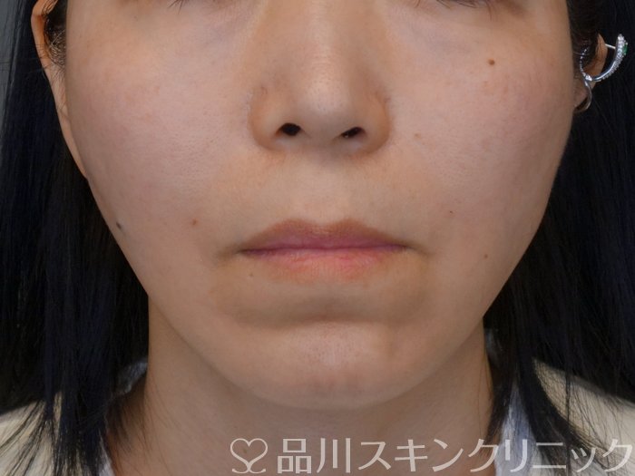 症例NO.73890のAFTER写真