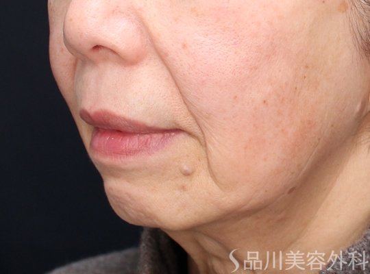 症例NO.73294のBEFORE写真