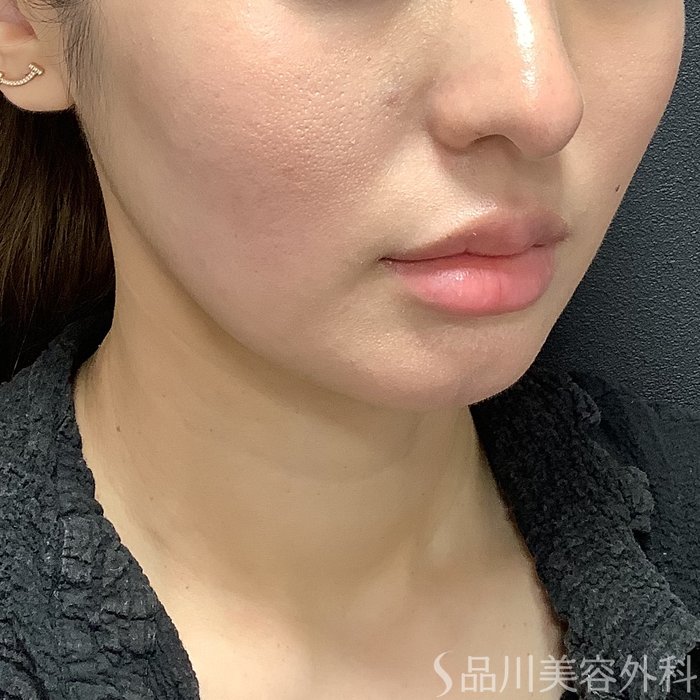 症例NO.75326のAFTER写真