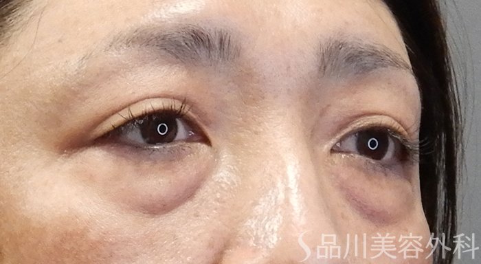 症例NO.70095のBEFORE写真