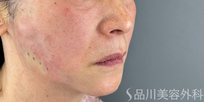 症例NO.72447のAFTER写真