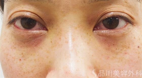 症例NO.31951のAFTER写真