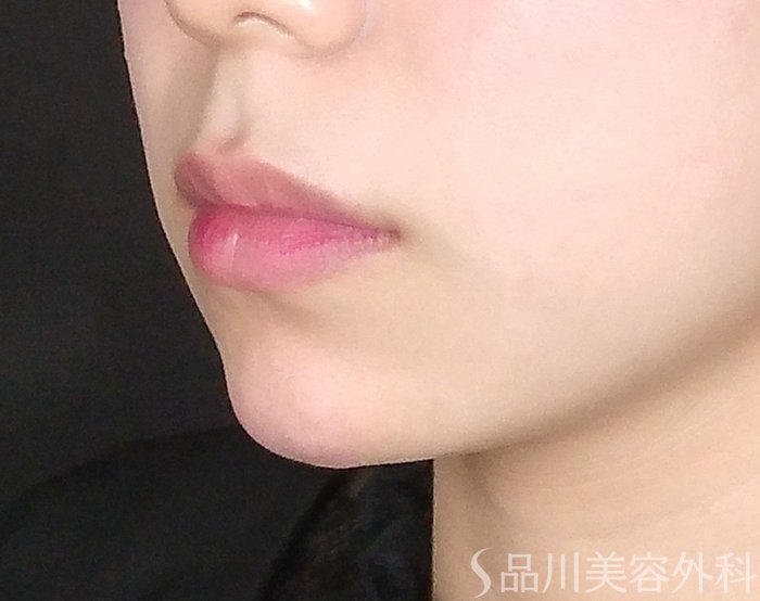 症例NO.65372のAFTER写真