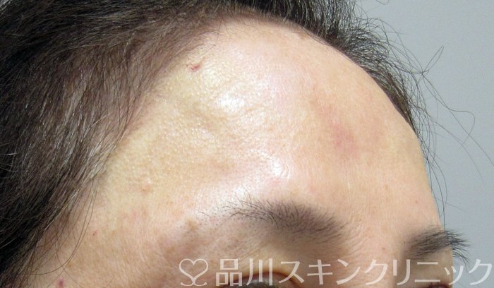 症例NO.74418のAFTER写真