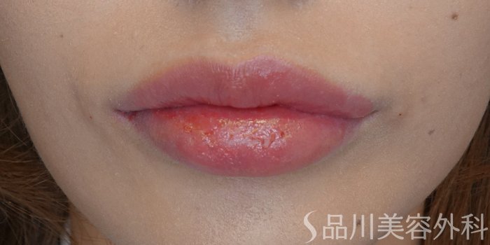 症例NO.71474のAFTER写真