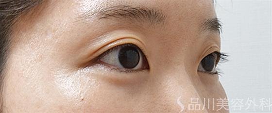 症例NO.52200のBEFORE写真