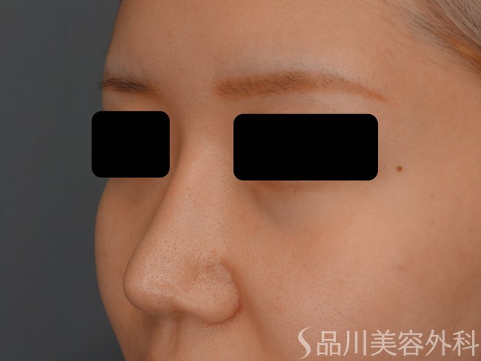 症例NO.73395のAFTER写真