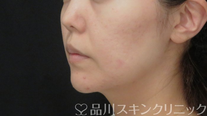 症例NO.72624のBEFORE写真