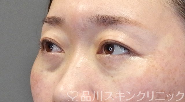 症例NO.64501のAFTER写真