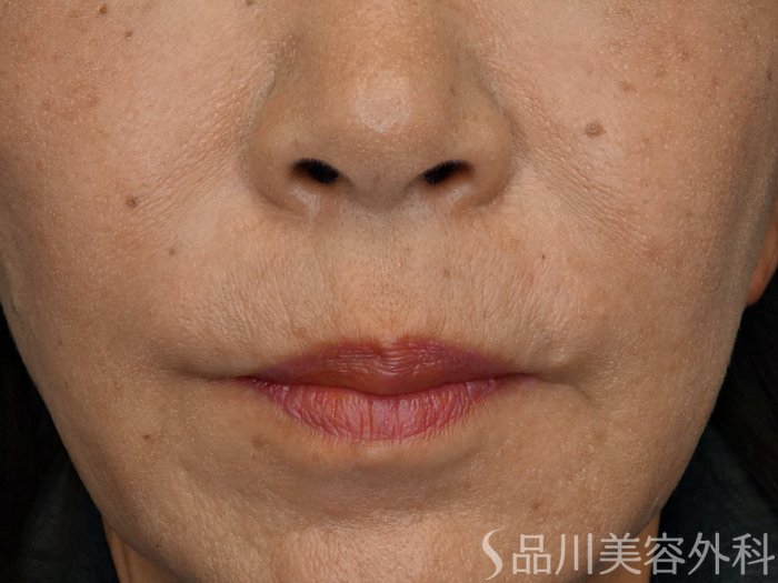 症例NO.69226のBEFORE写真