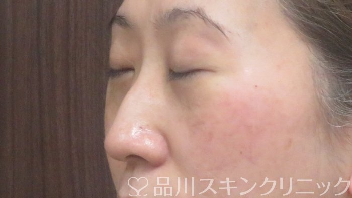 症例NO.72643のAFTER写真