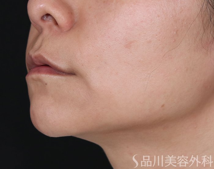 症例NO.71893のBEFORE写真