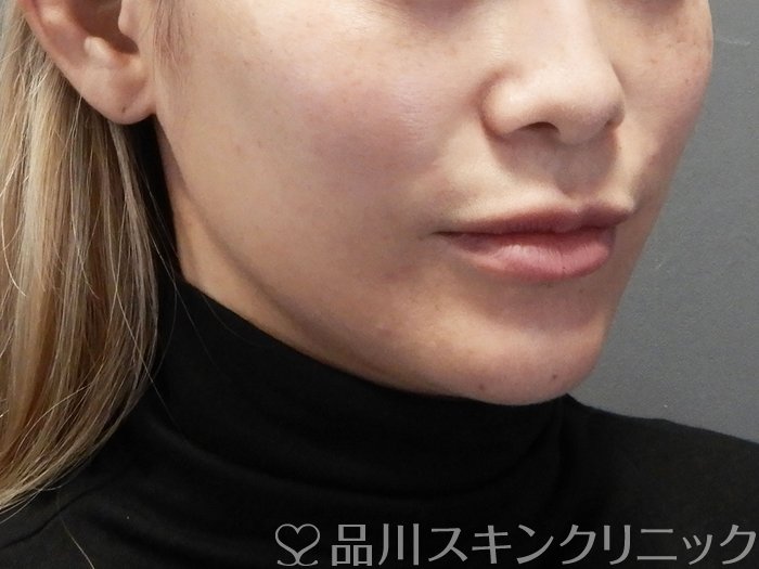 症例NO.72852のAFTER写真