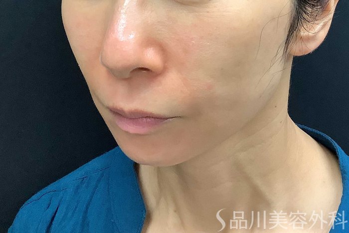 症例NO.69840のAFTER写真