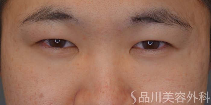 症例NO.74726のBEFORE写真