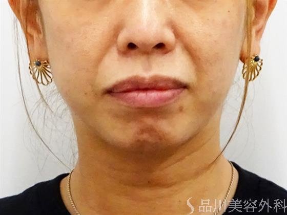 症例NO.52472のBEFORE写真