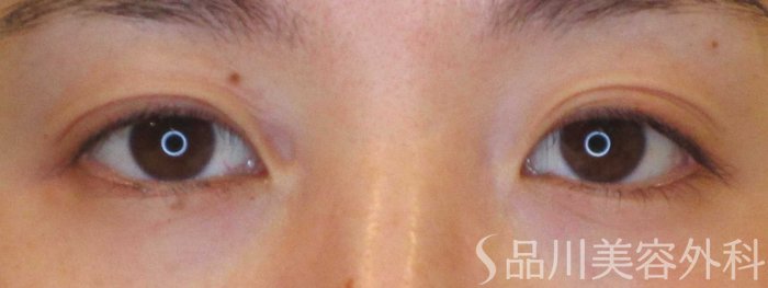 症例NO.69802のBEFORE写真