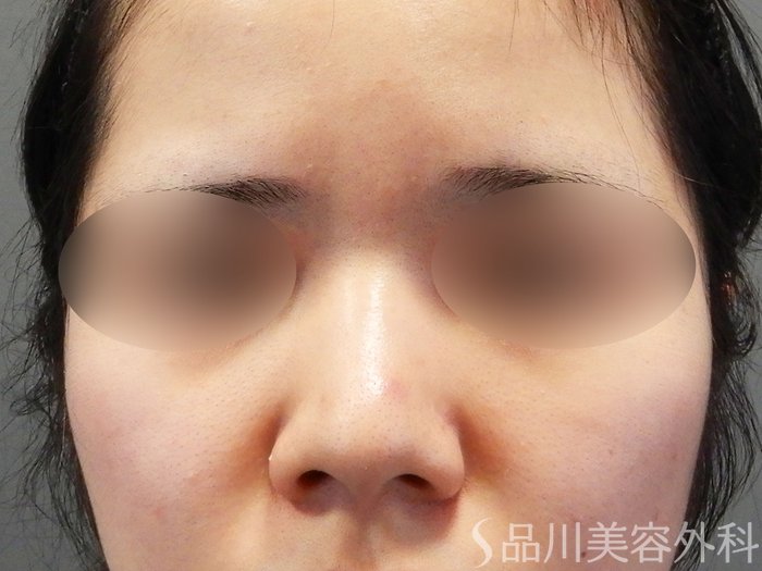 症例NO.71066のBEFORE写真