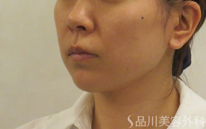 症例NO.72461のBEFORE写真