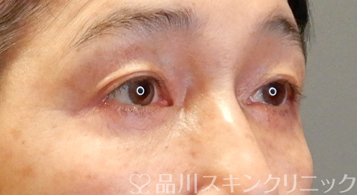 症例NO.64331のAFTER写真