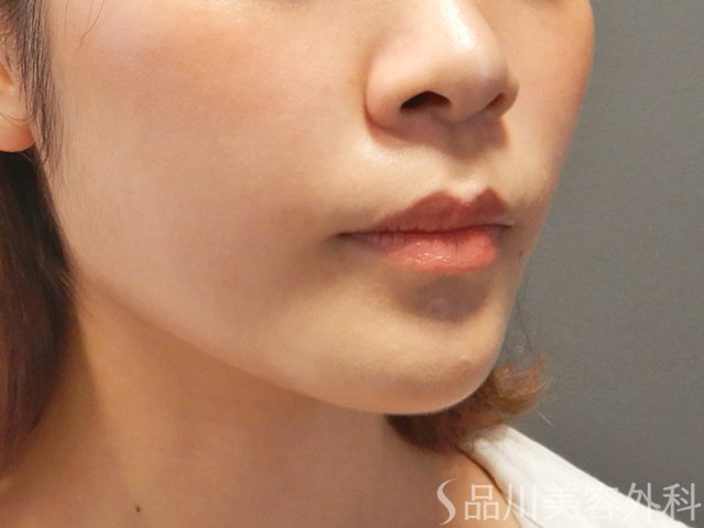 症例NO.71798のAFTER写真