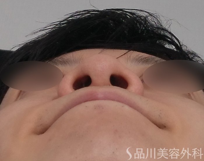 症例NO.70649のBEFORE写真