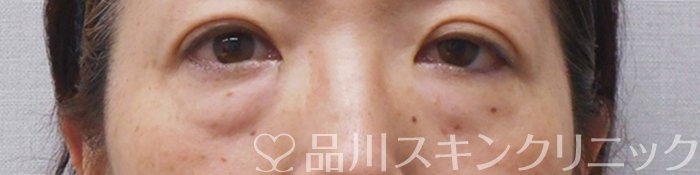 症例NO.72408のBEFORE写真