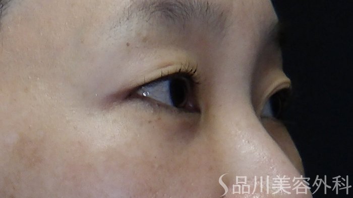 症例NO.73668のBEFORE写真