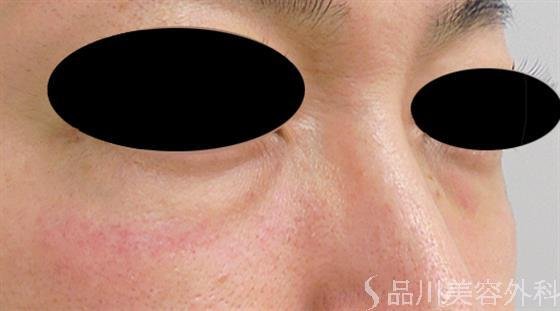 症例NO.46383のBEFORE写真